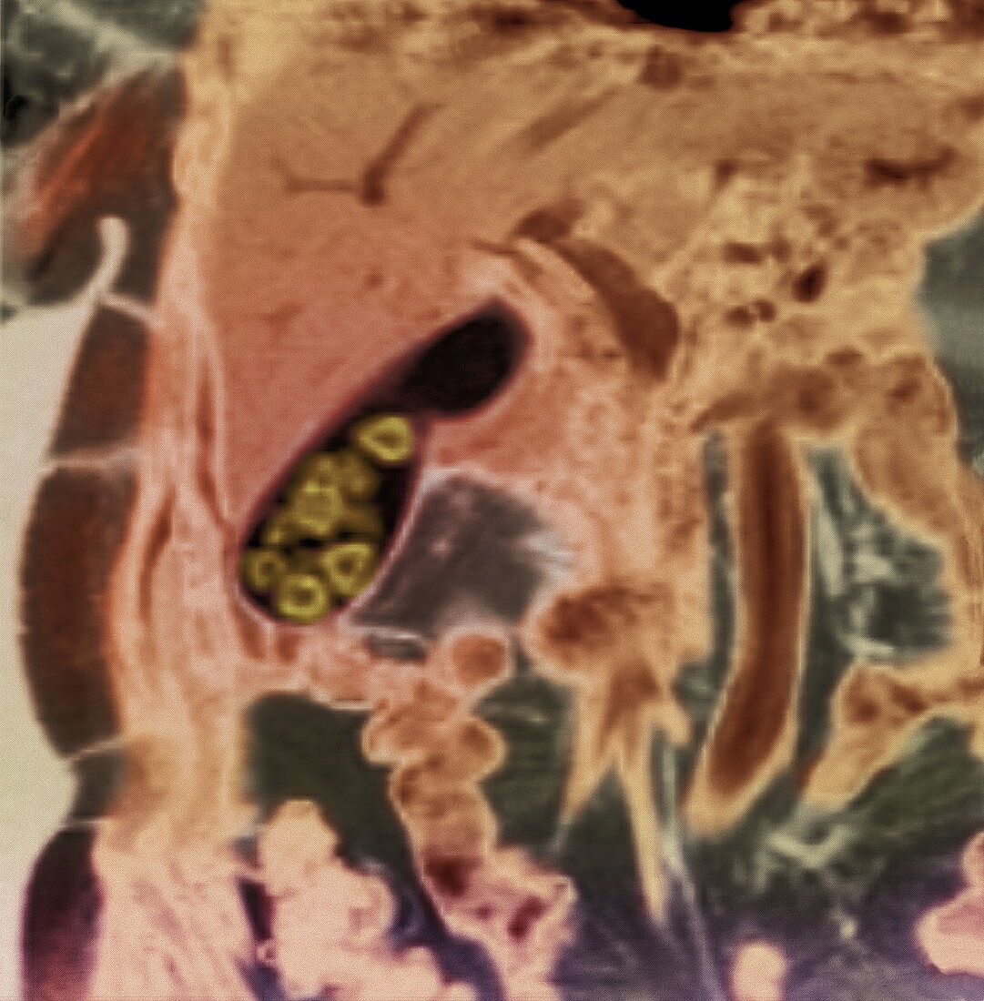 Gallstones,MRI scan