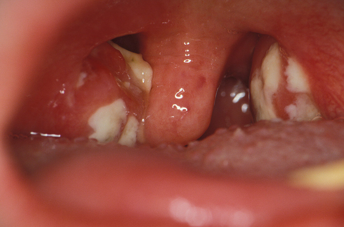 Tonsils in glandular fever