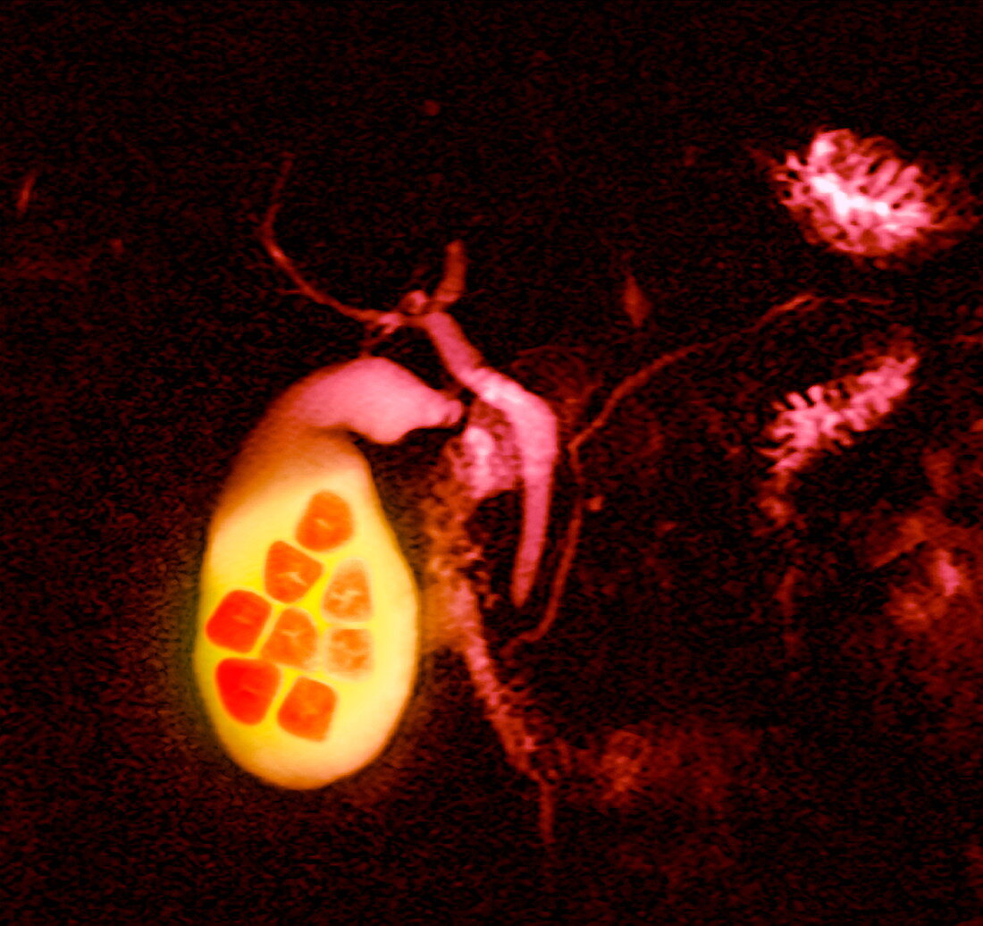 Gallstones