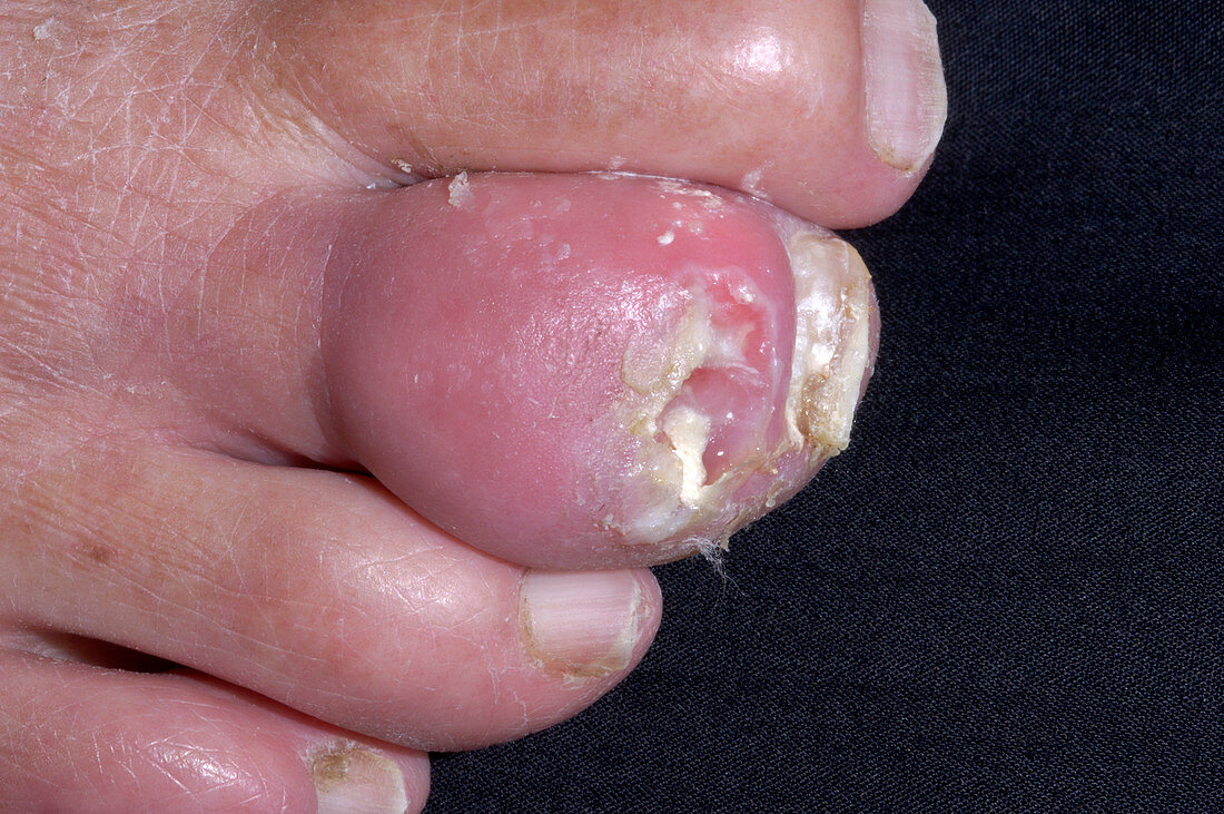 Gouty tophus of a toe