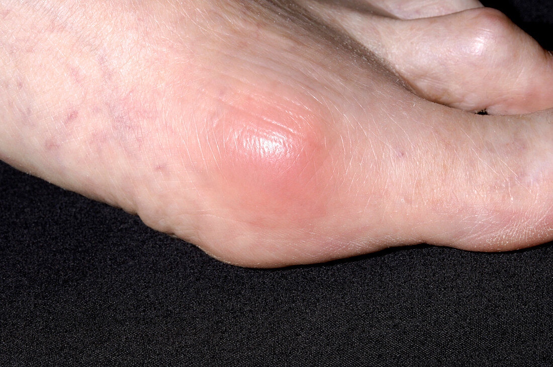 Gout joint inflammation