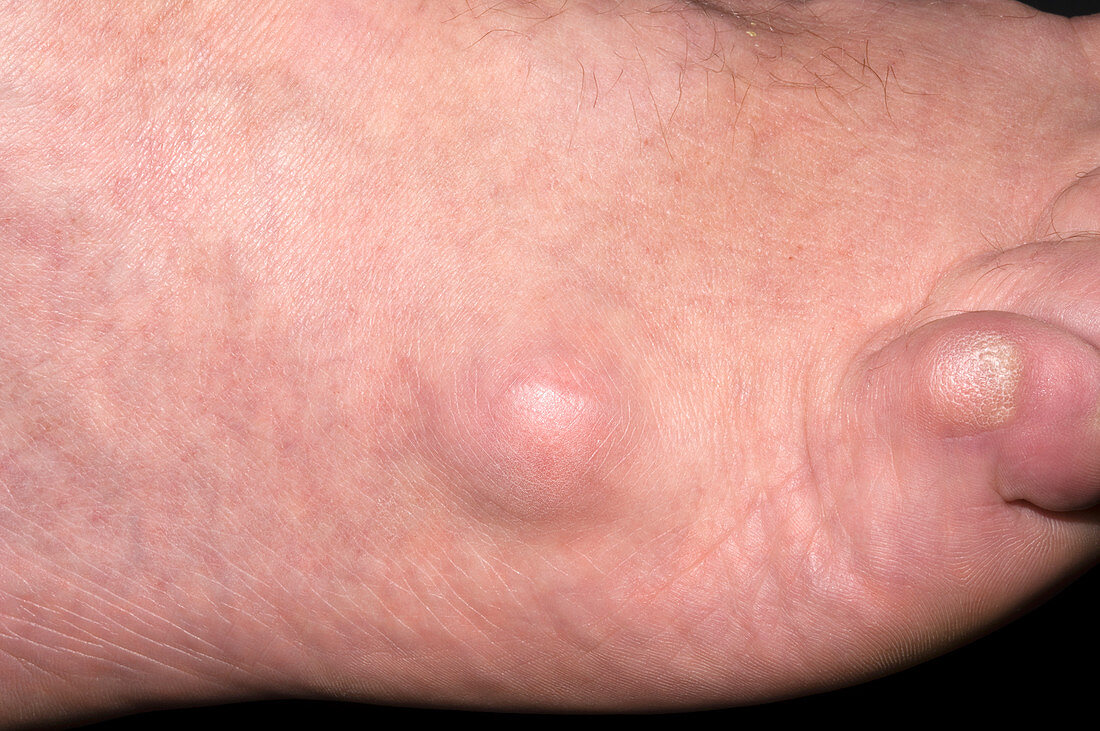 Ganglion on foot
