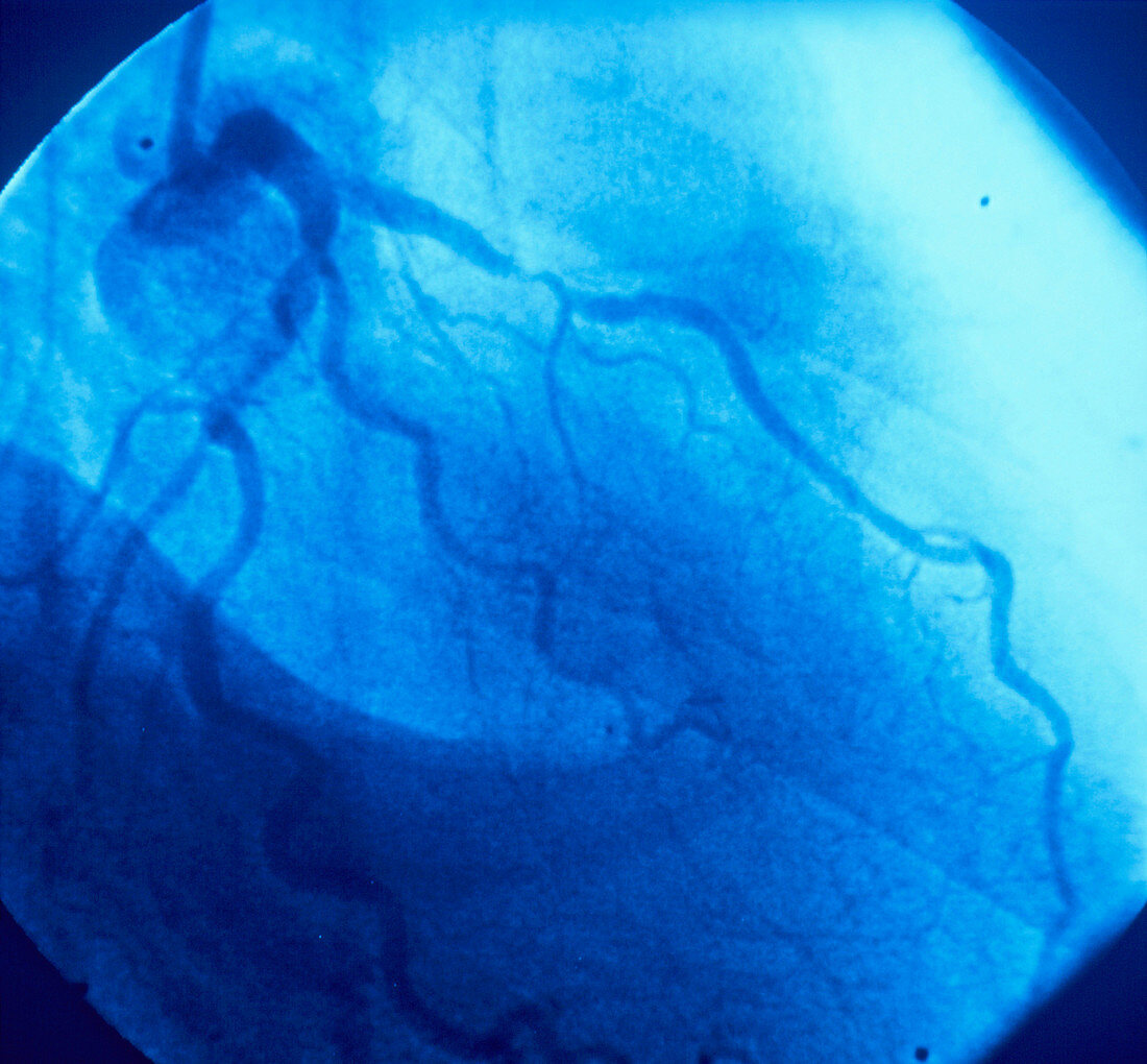 Narrowing of coronary artery