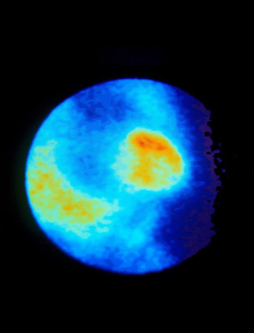 Coloured Gamma Scan of heart showing angina