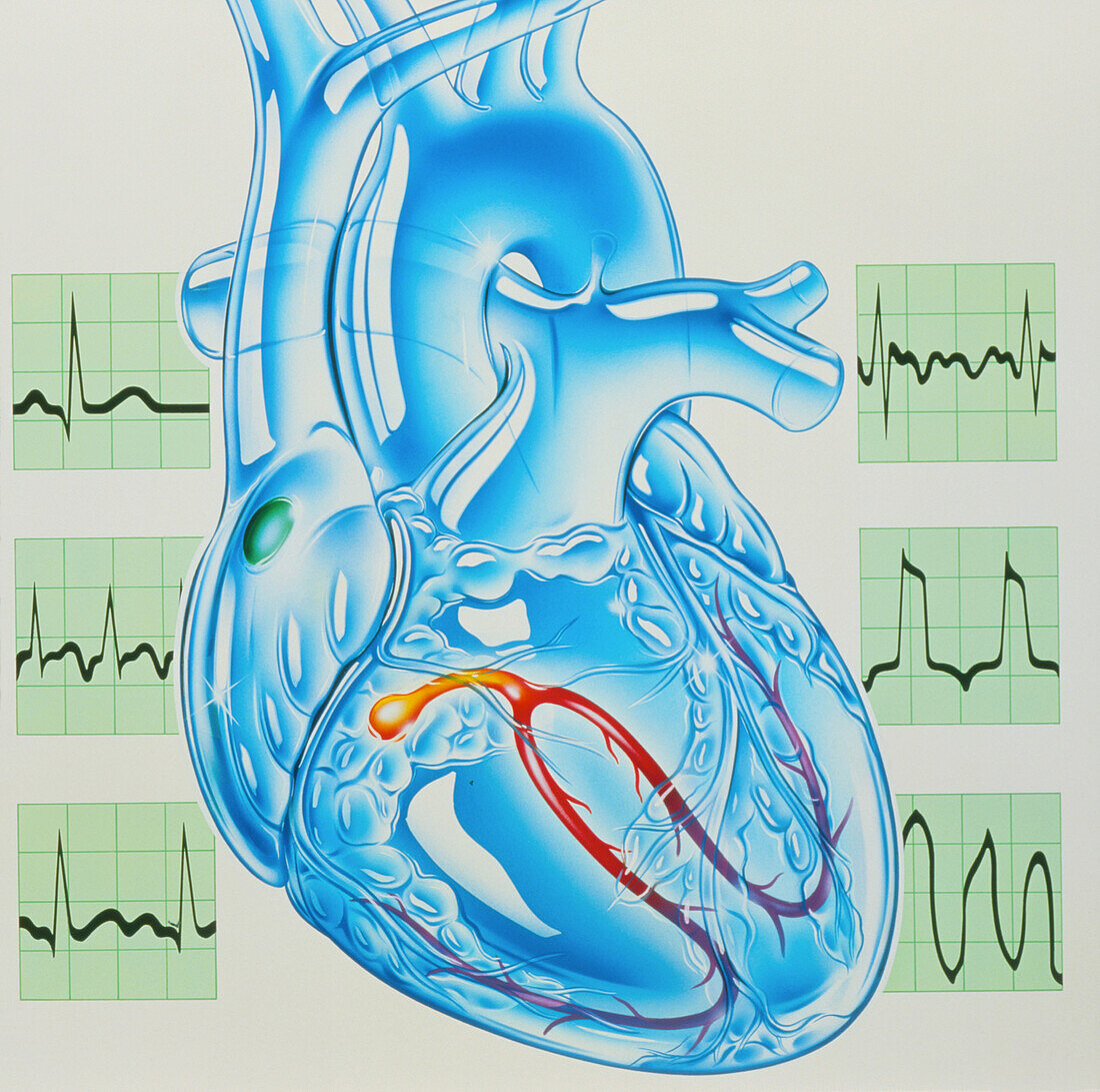 Artwork of cardiac arrhythmia with heart & ECGs