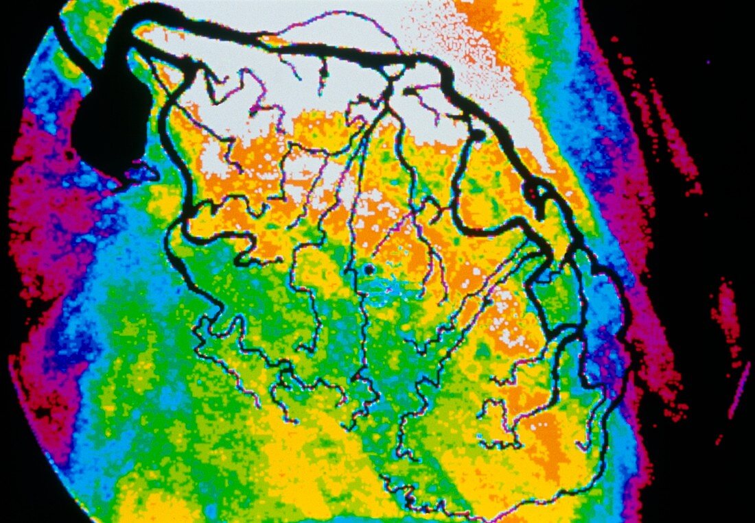 Coloured angiogram of coronary artery narrowing