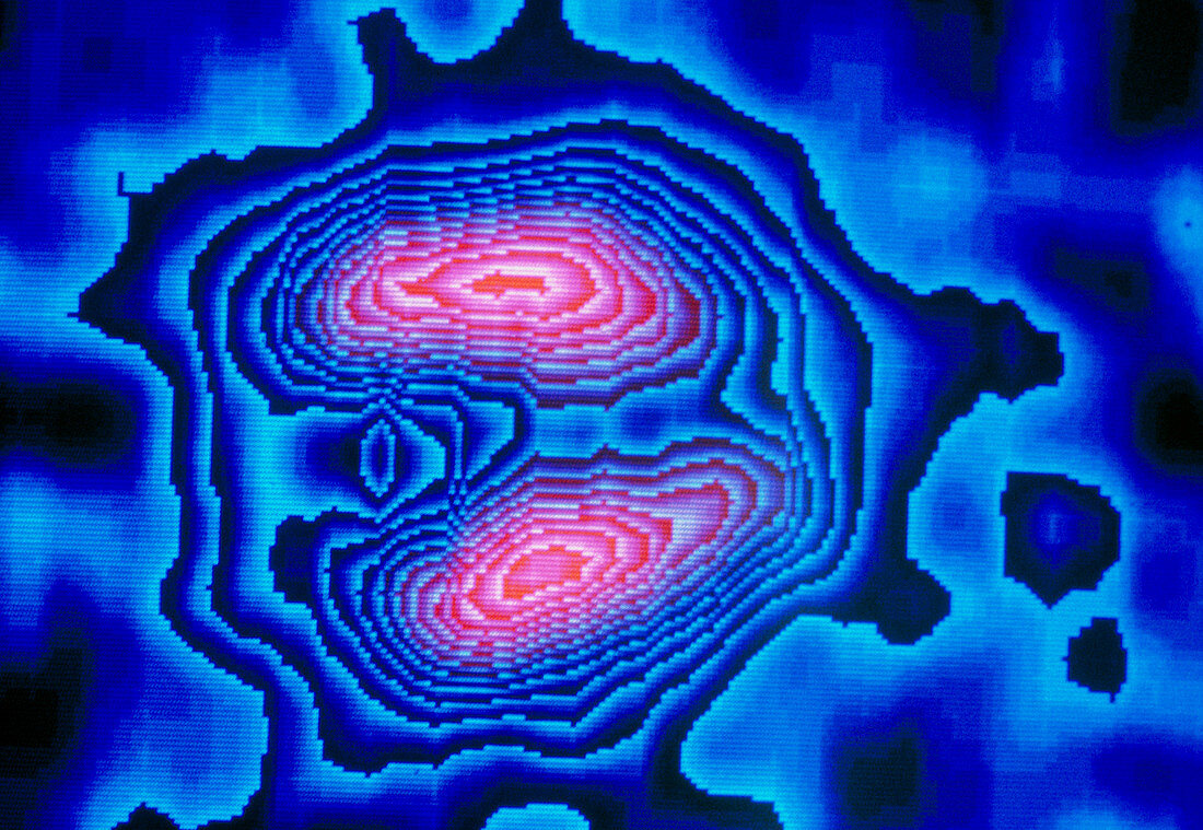 Coloured Gamma Scan of heart after heart attack