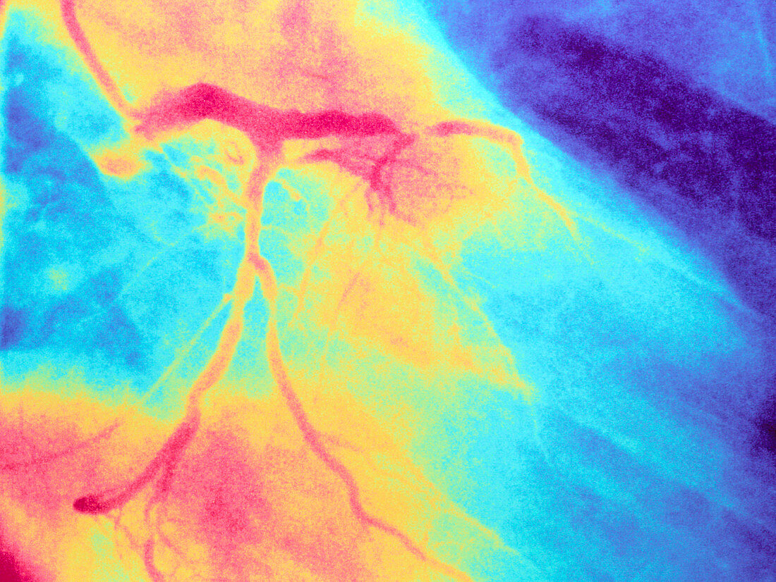 Colour angiogram of left coronary artery stenosis