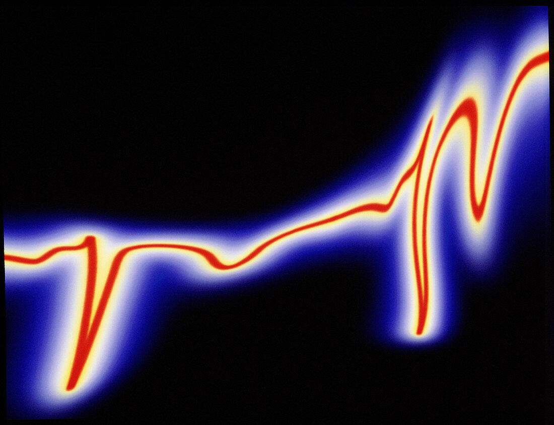 Heart disease: artwork of an irregular ECG trace
