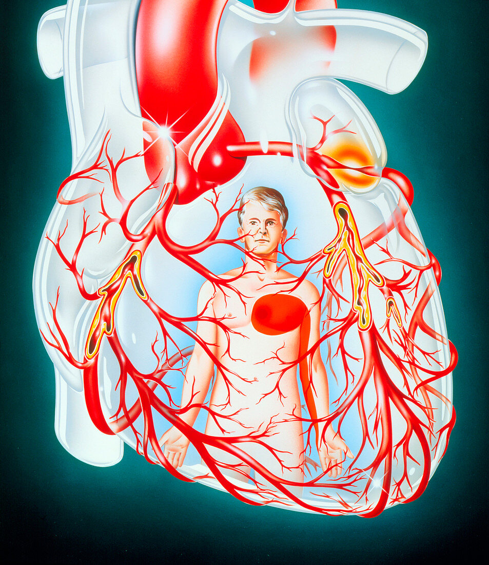 Illustration of heart showing the cause of angina