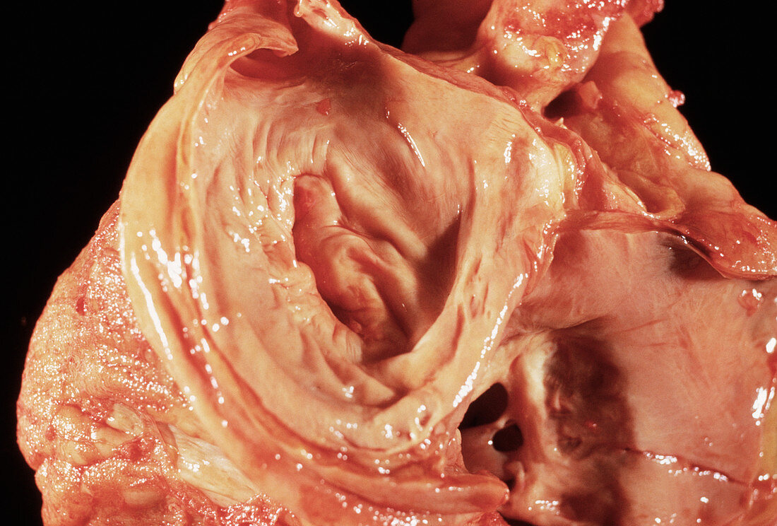 Diseased heart valve