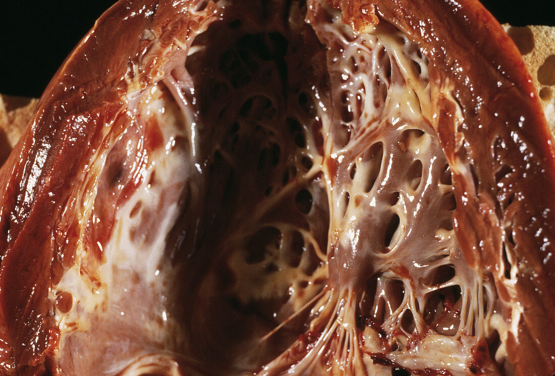 Heart fibroelastosis