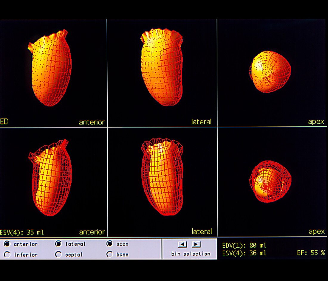 Heart after heart attack,3D models