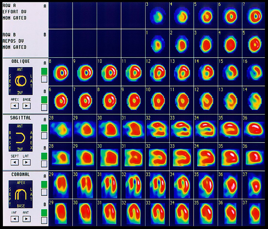 Heart after heart attack,gamma scans