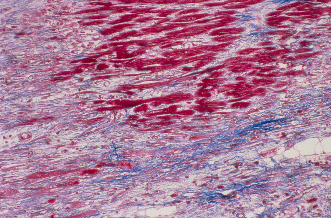 Diseased heart tissue,light micrograph