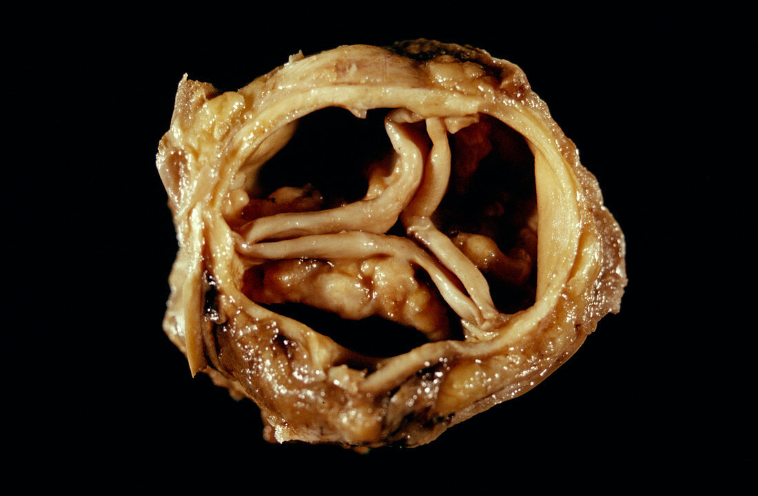 Narrowed aortic valve