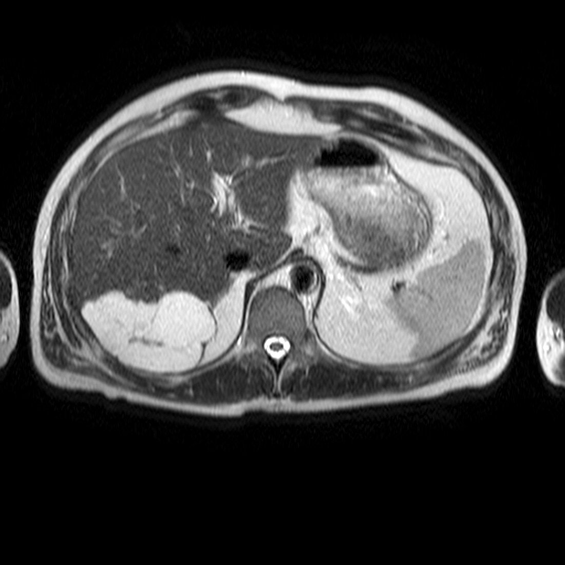 Liver blood vessel tumour,MRI scan