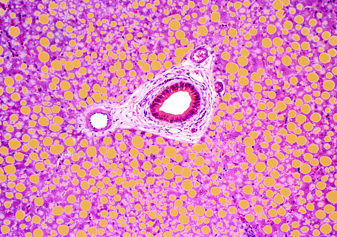 Alcoholic hepatitis,light micrograph