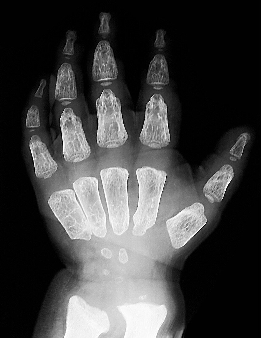 Hurler syndrome,X-ray