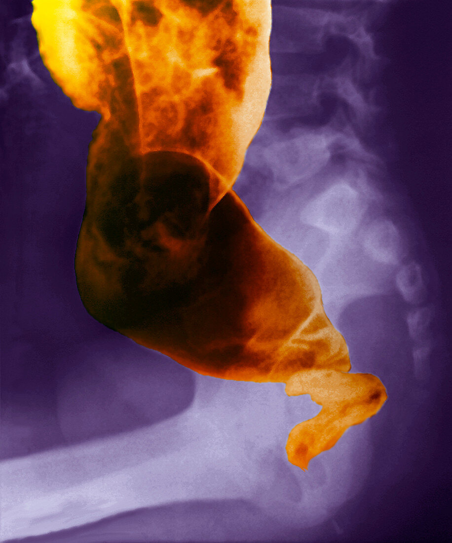 Hirschsprung's disease,X-ray