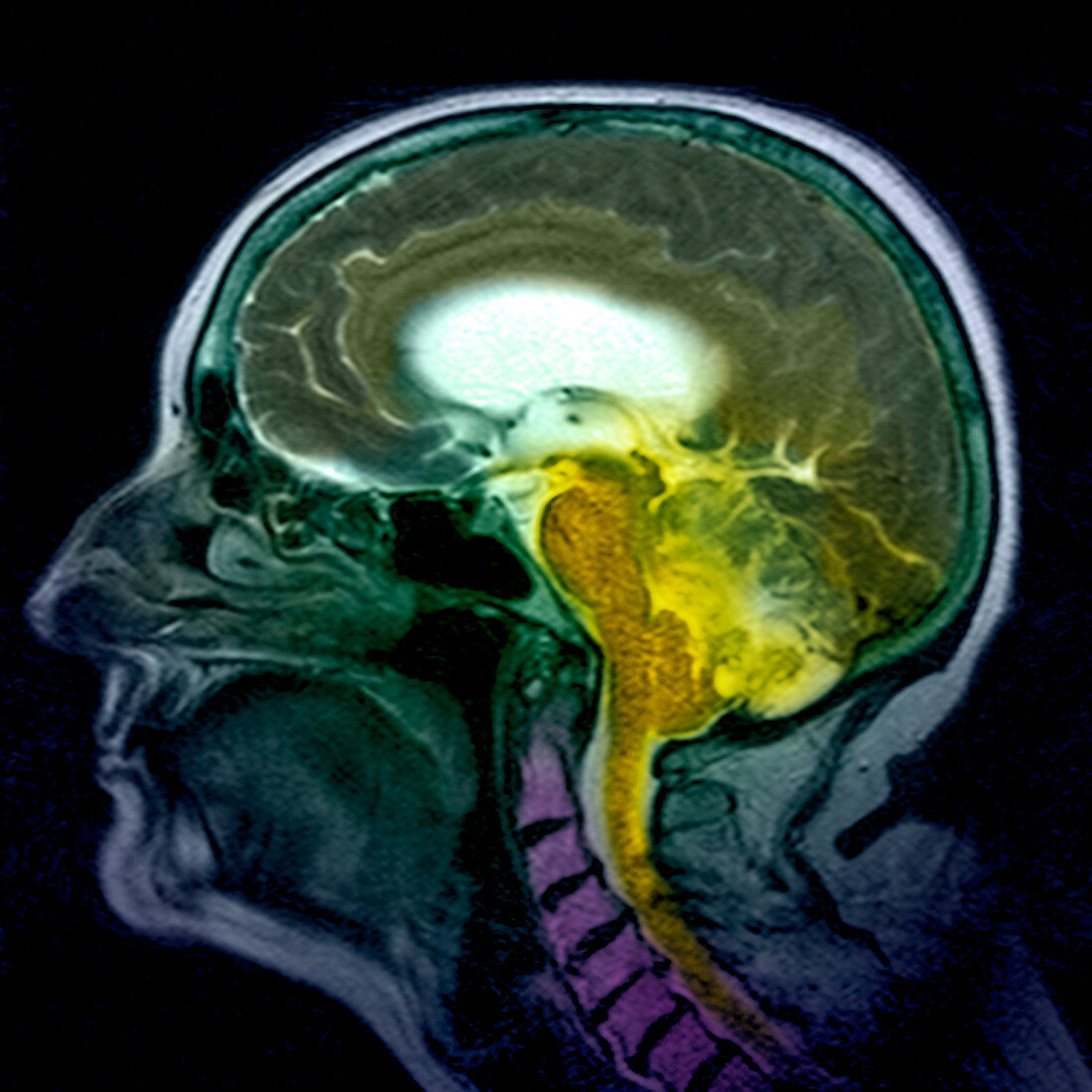 Haemangioblastoma brain tumour,MRI scan