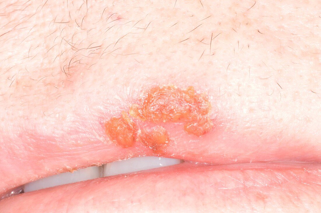 Cold sore lesion on upper lip
