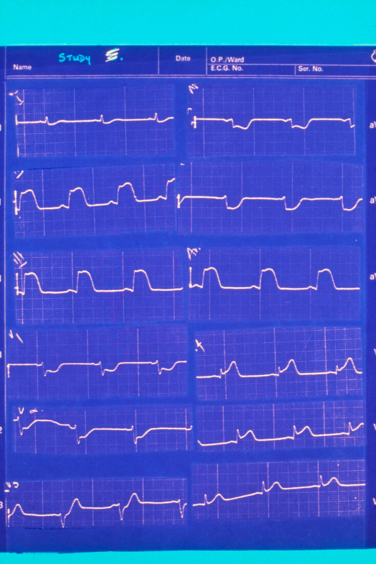 ECG pattern of person suffering a heart attack