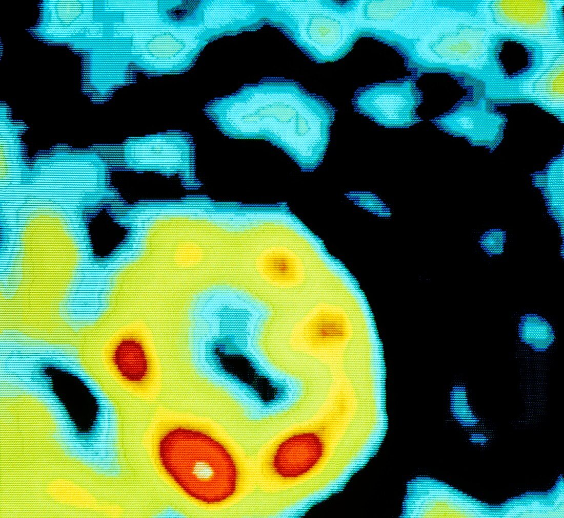 Scintigram showing multiple heart infarctions