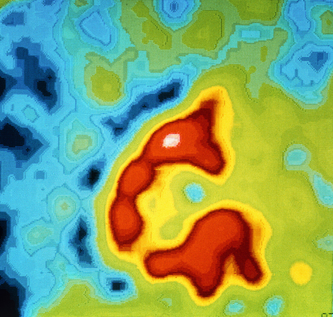 Scintigram showing ischaemia post heart attack