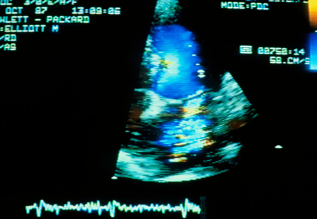 Colour echocardiogram of the human heart