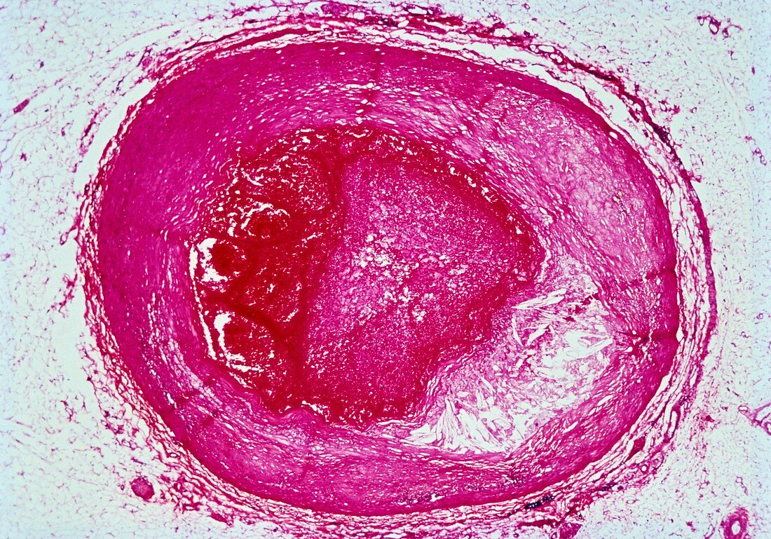 LM of section through human coronary artery