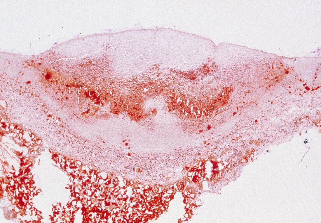 LM of a cross-section through an atheroma plaque