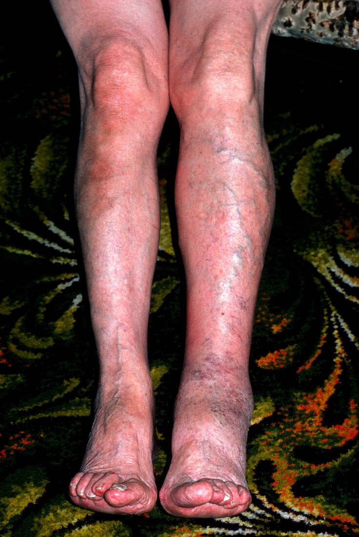 Patient's leg affected by deep vein thrombosis