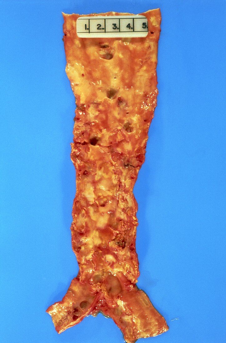 Cross-section of aorta showing atheroma plaques