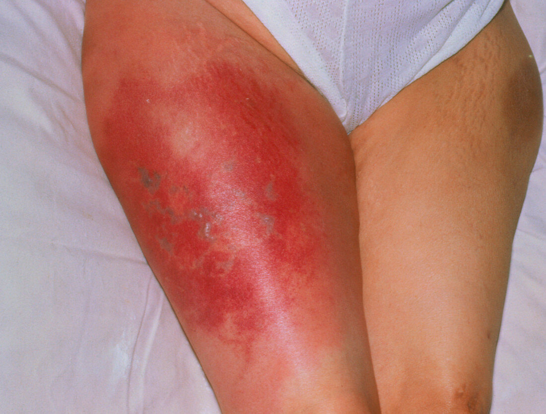 Deep vein thrombosis (DVT) in a woman's thigh