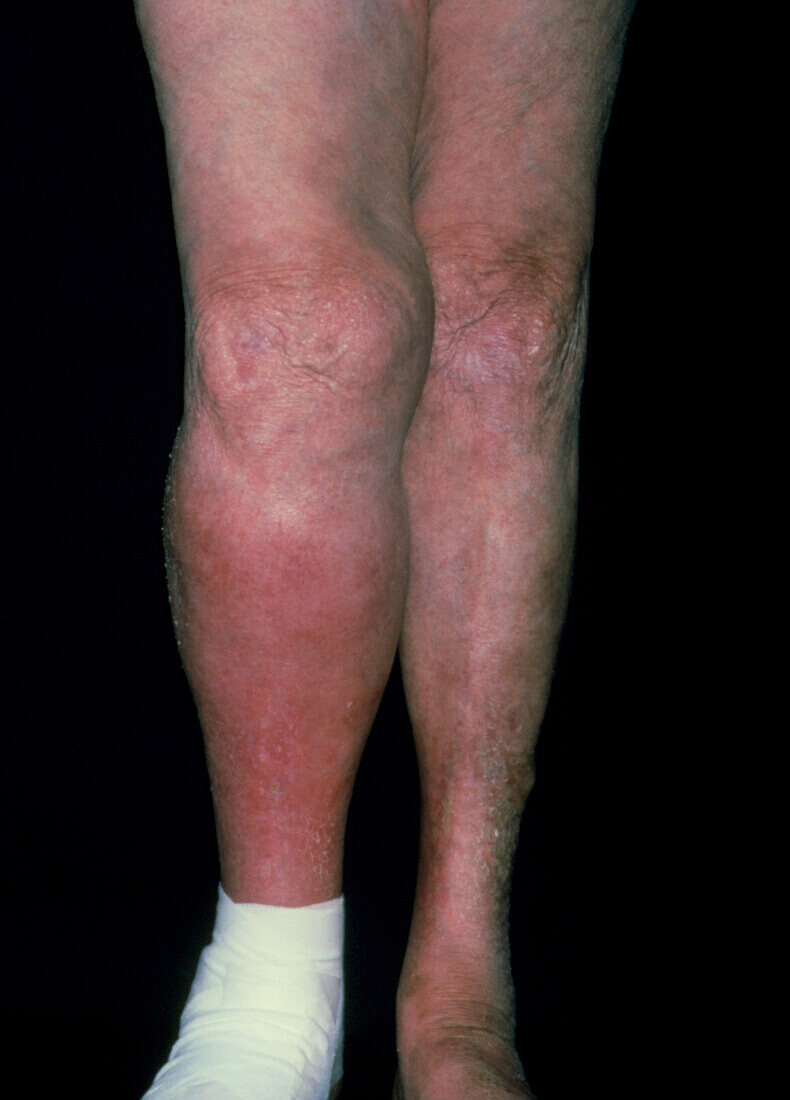 Deep vein thrombosis in the lower leg of a patient