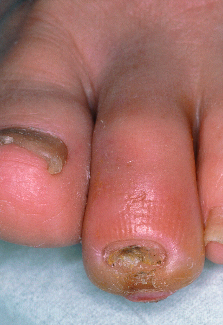 Ischaemic toe in patient with diabetes