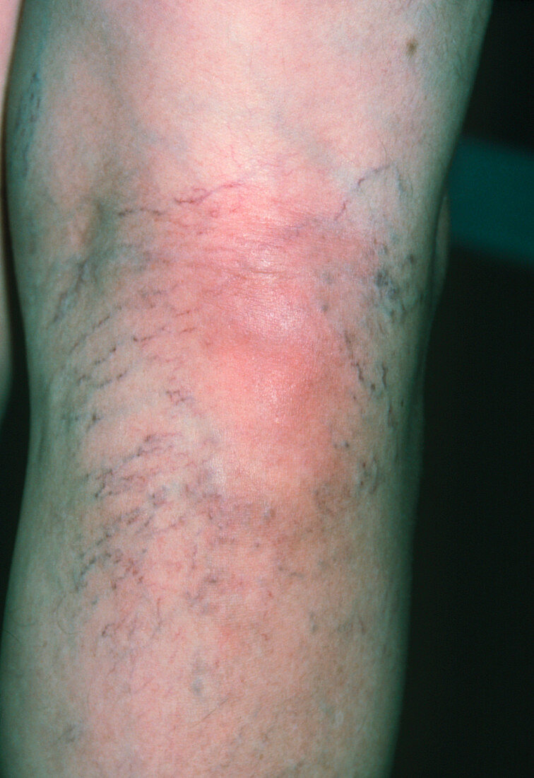 Superficial thrombophlebitis in 60-year-old woman