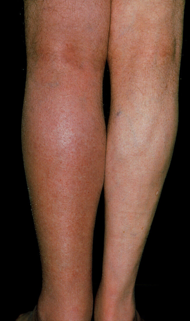 Deep vein thrombosis in the left leg of a patient