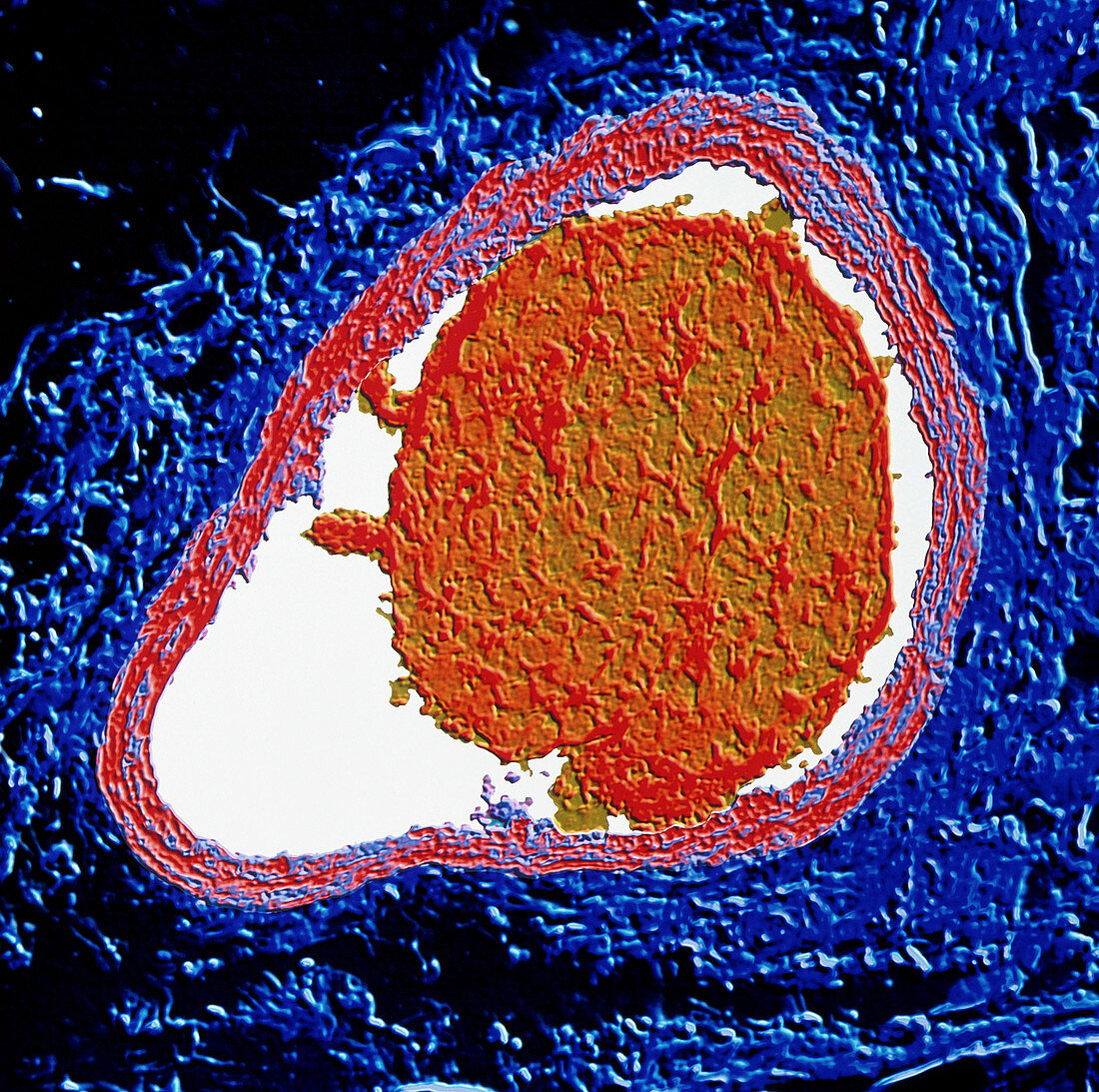Computer artwork of venous thrombus in leg