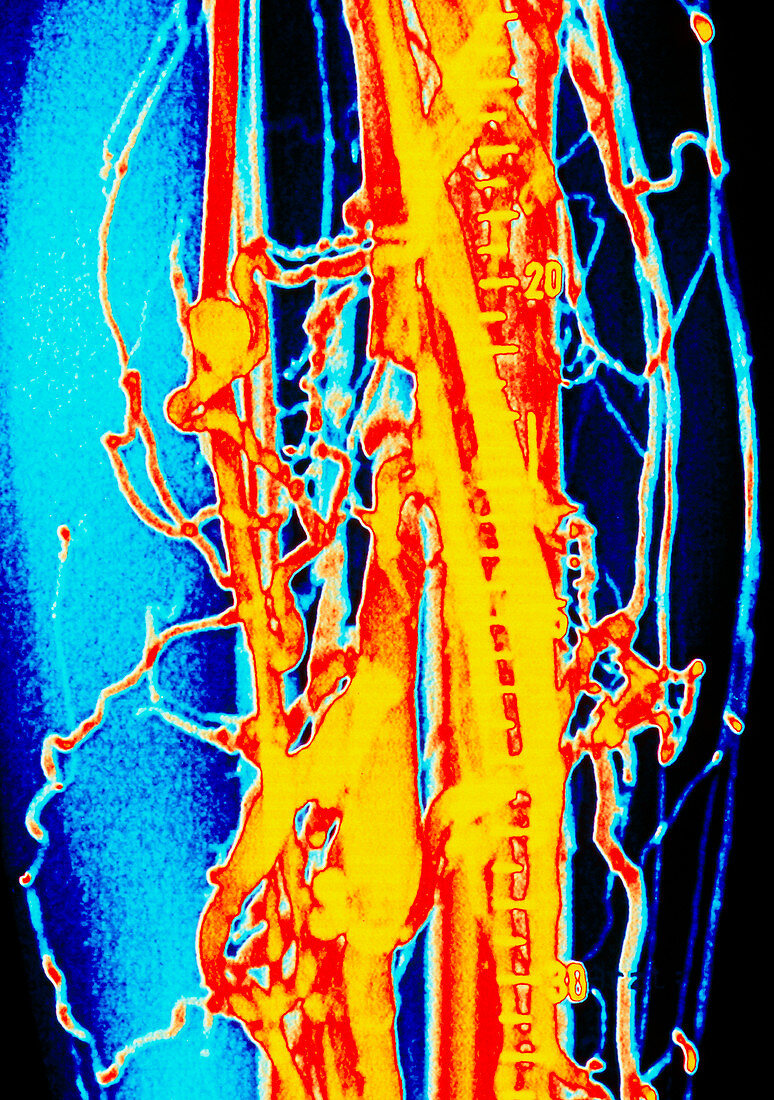Coloured venogram of phlebitis in leg of patient