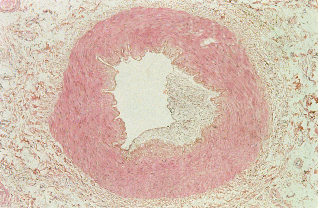 LM of a section through atheroma in an artery