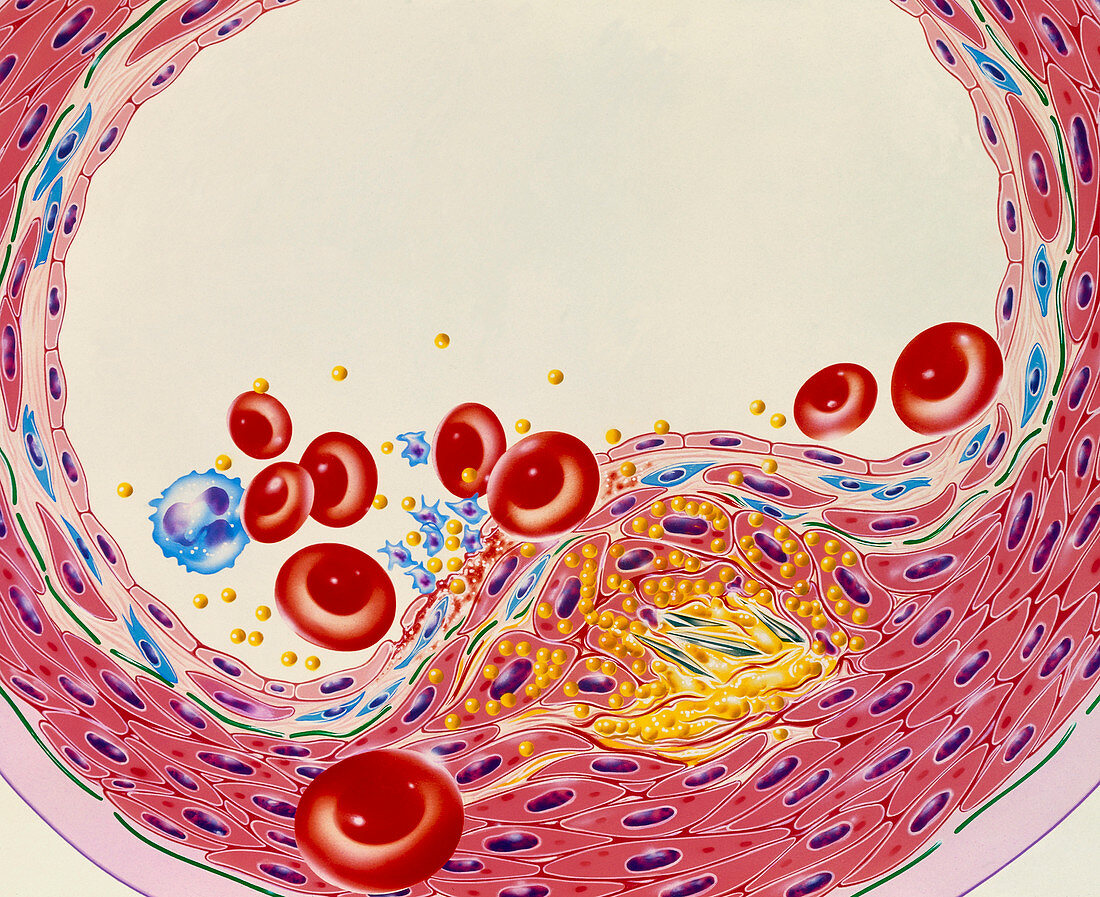 Artwork of artery narrowed by atherosclerosis