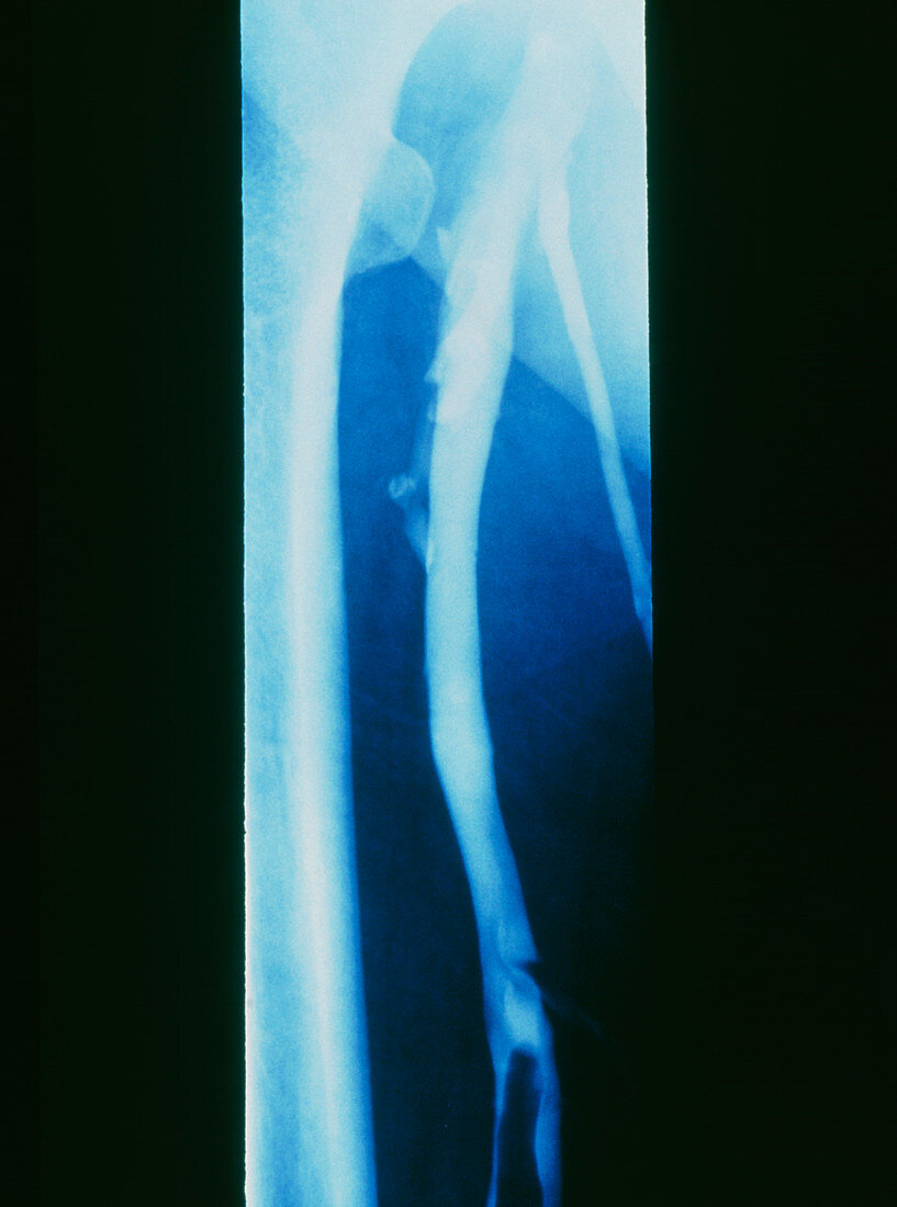 Thrombophlebitis in a leg vein