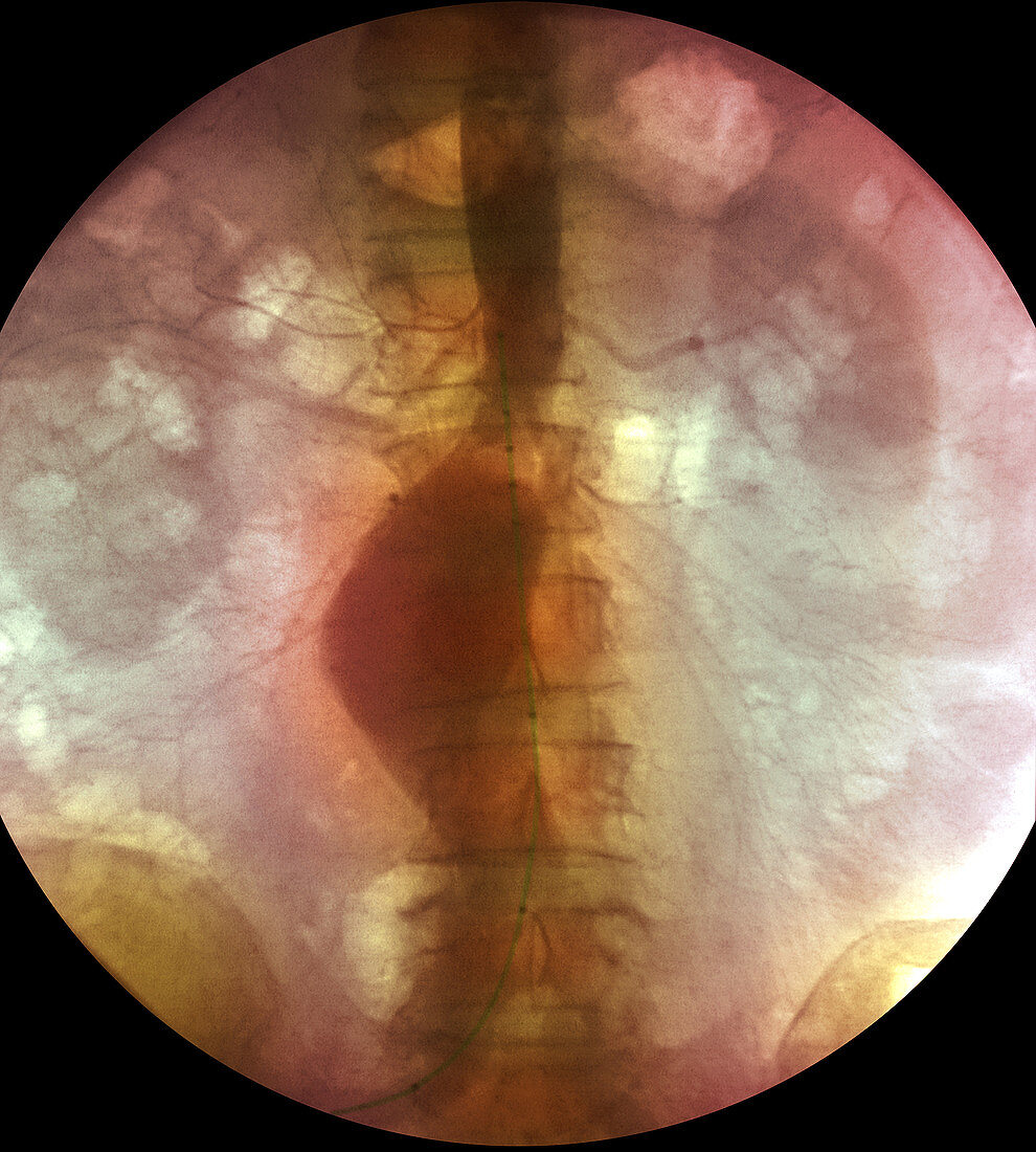 Aortic aneurysm