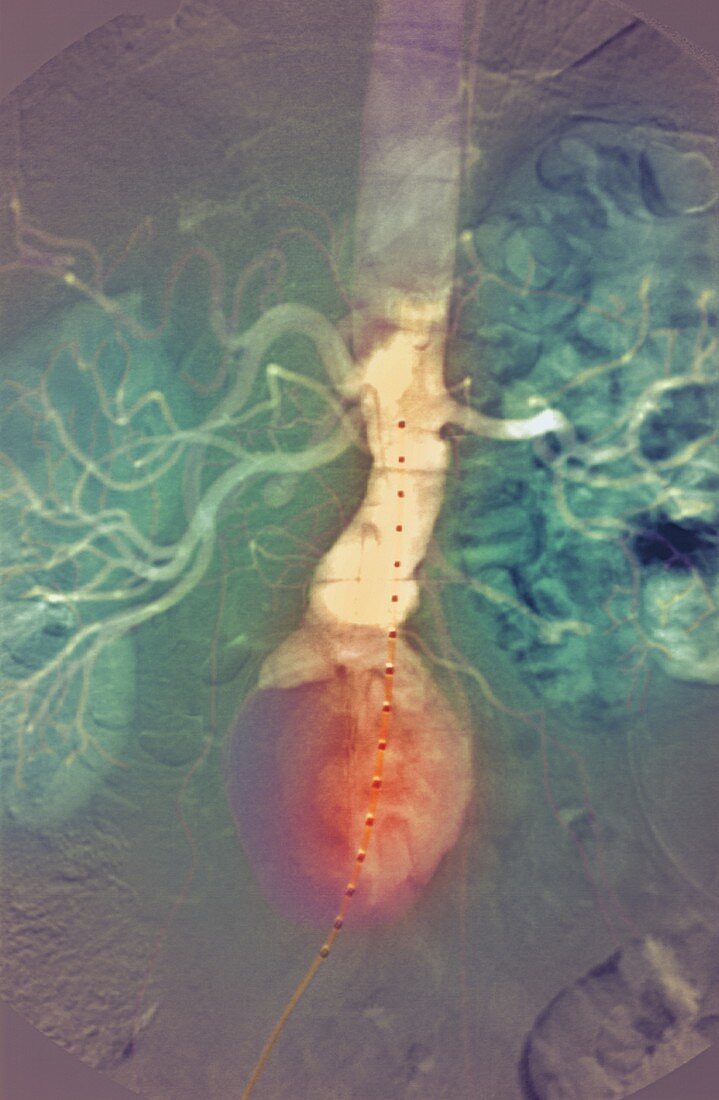 Aortic aneurysm,X-ray