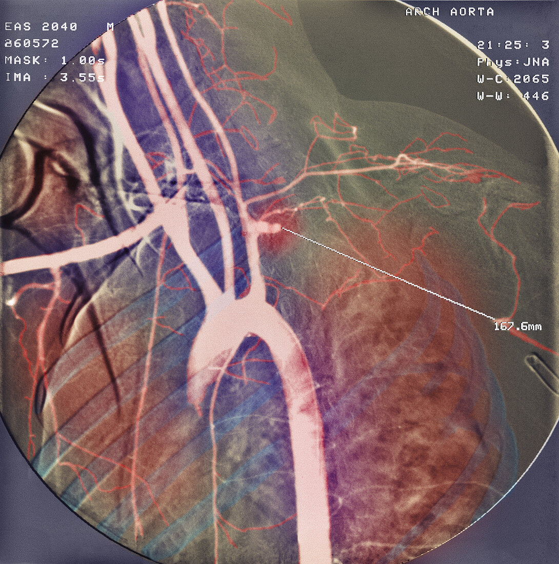 Blocked artery,X-ray