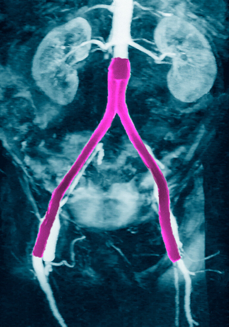 Aortic bypass,MRA