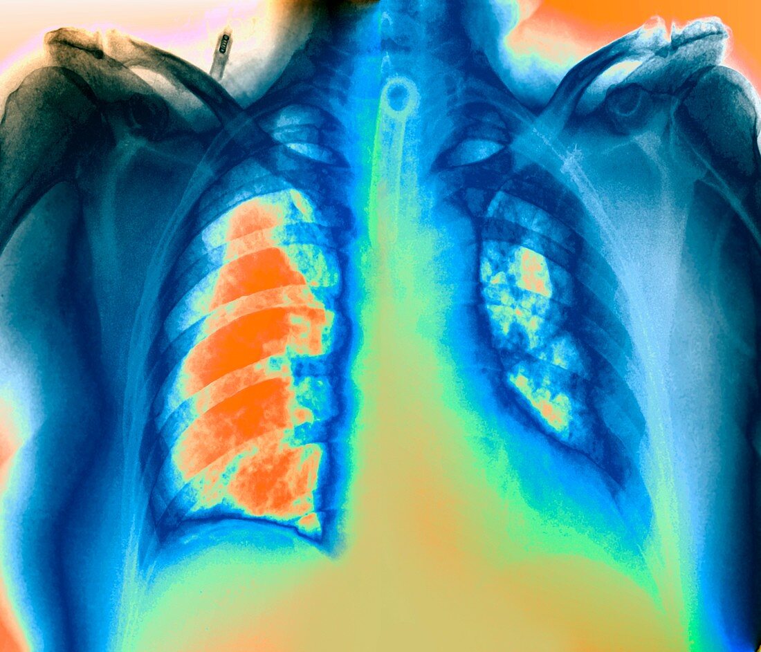 Pulmonary embolism,X-ray