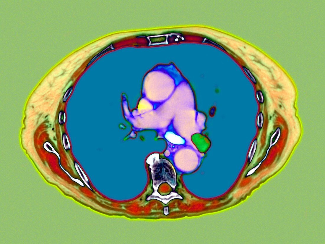 Pulmonary embolism,CT scan